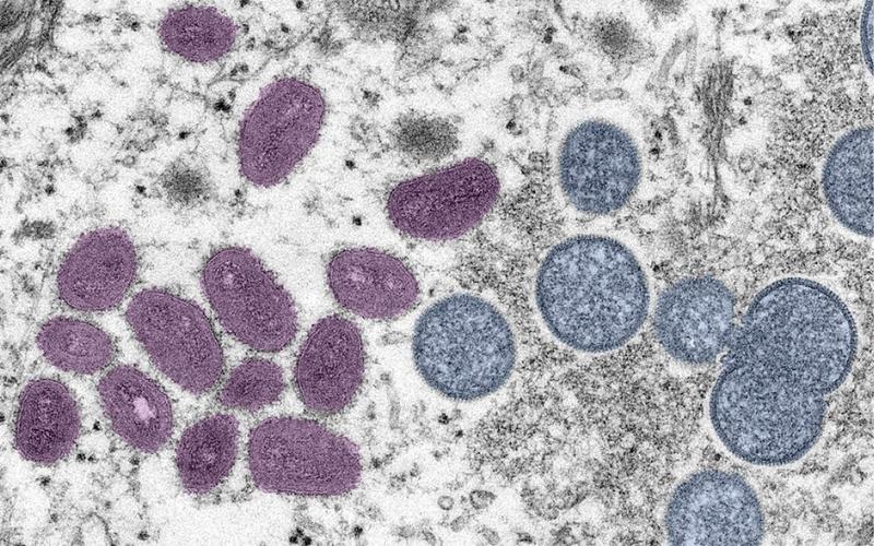 Another Monkeypox Case in Area Health District